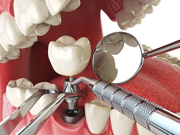 Best Emergency Wisdom Teeth Removal in Yuipa, CA